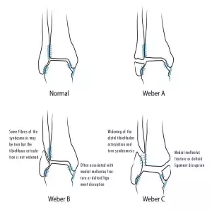 Weber Classification